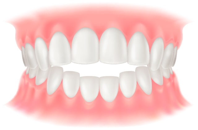矯正歯科の主な歯列不正例　開咬（かいこう）