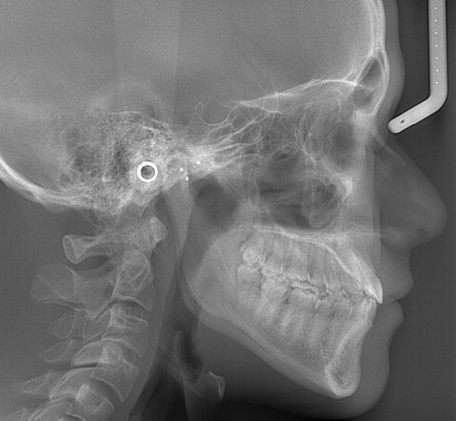 矯正治療のための検査　セファロ分析